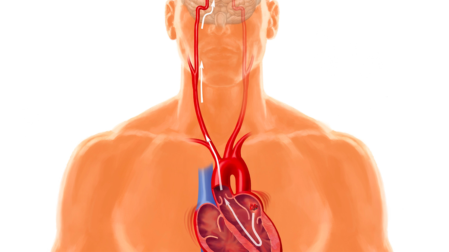Actividad física, estado cardiorrespiratorio y resultados cardiovasculares en individuos con fibrilación auricular: el estudio HUNT